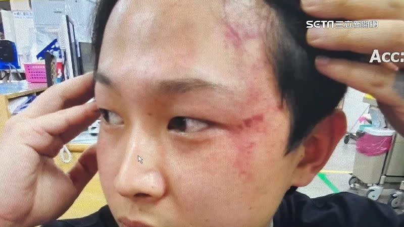 男子被打到整張臉從眼尾到額頭幾乎都是傷。