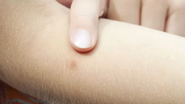 La piel humana es más fácil de perforar para un mosquito que la de otros vertebrados