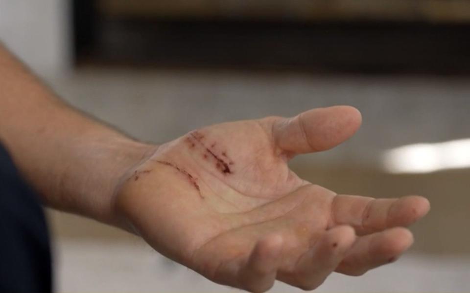 Caleb Adams's hand following the shark attack