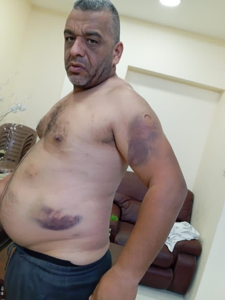 A photo provided by Palestinian activist Mohammed Mattar shows bruises he says he got from Israeli settlers who kidnapped him in the West Bank. / Credit: Courtesy of Mohammed Mattar