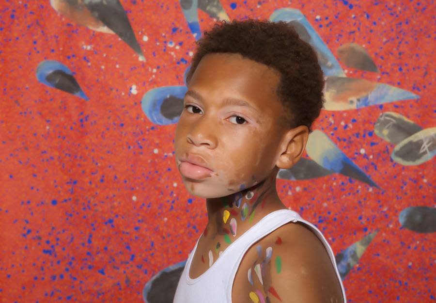 Stunning Portraits Perfectly Capture the Beauty of People Living With Vitiligo