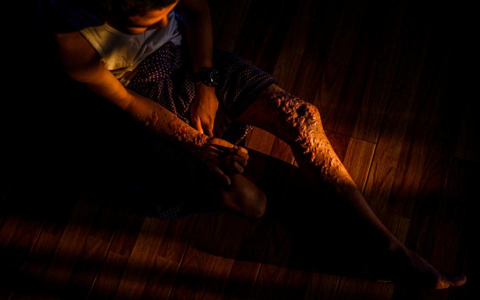14-year-old Paing, from Kayah State, stepped on a landmine while searching for his family's injured cow at a neighborhood farm in eastern Myanmar. His lost his right leg, and his hands & other leg were badly injured.