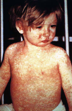 <span class="caption">Measles is a highly infectious viral disease.</span> <span class="attribution"><a class="link " href="https://commons.wikimedia.org/w/index.php?curid=210382" rel="nofollow noopener" target="_blank" data-ylk="slk:CDC/NIP/Barbara Rice;elm:context_link;itc:0;sec:content-canvas">CDC/NIP/Barbara Rice</a></span>