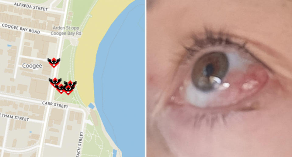 Left, the five magpie swooping incidents reported to Magpie Alert on the tracking map. Right, the mum's red and puffy eye one week after the injury. 