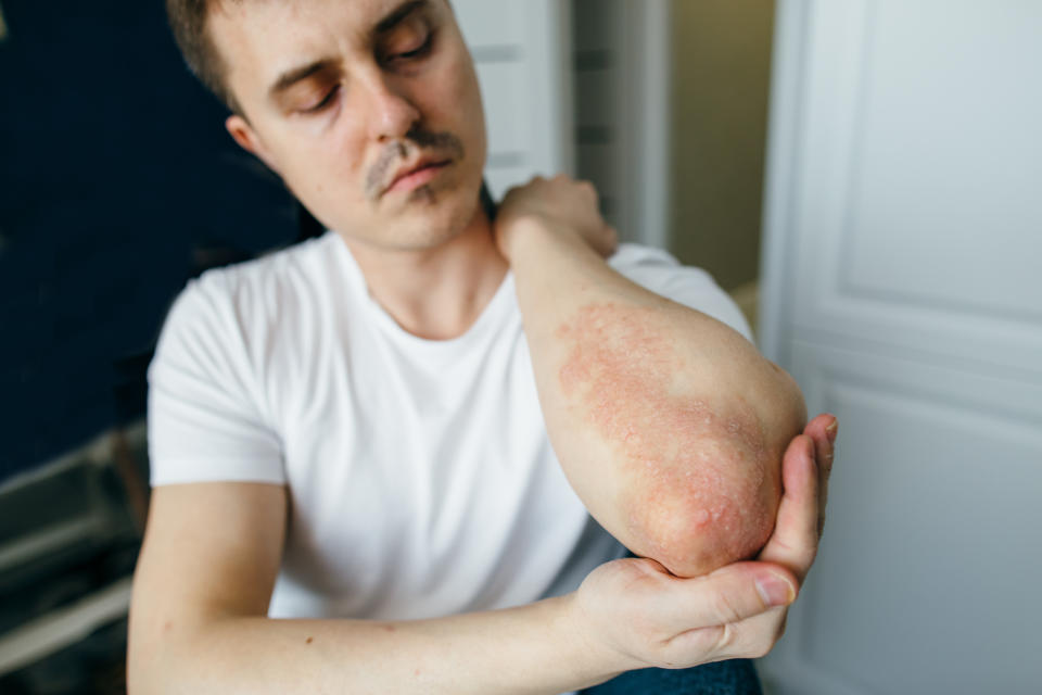 Man looks at the flaky skin on his hands with eczema, psoriasis and other skin diseases such as fungus, plaque, rash and spots. Autoimmune genetic disease.