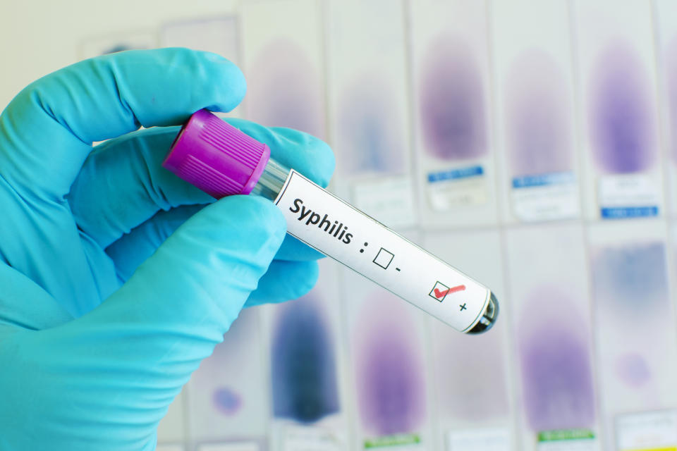 Blood sample with syphilis positive