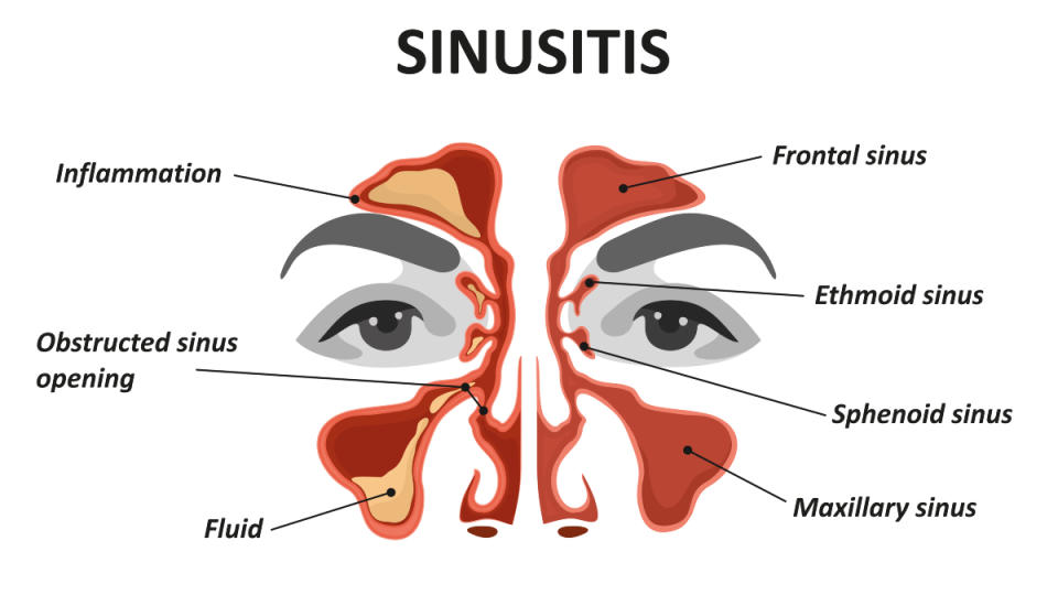 An illustration of sinusitis