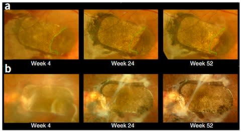 Scans show new darker cells growing around hte patch after a year  - Credit: UCL/Moorfields Eye Hospital