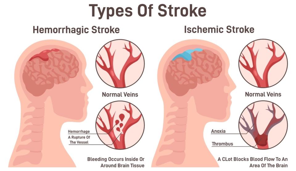 How taking aspirin can aid stroke prevention