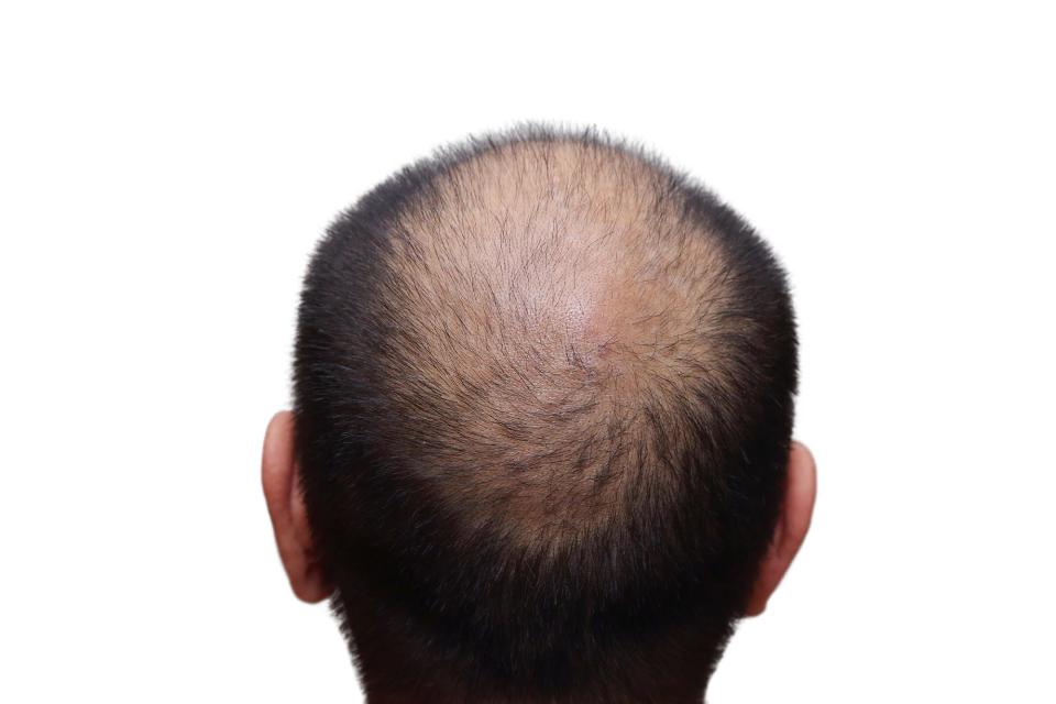 Research shows that some 90% of men will experience some form of hair loss during their lifetimes.