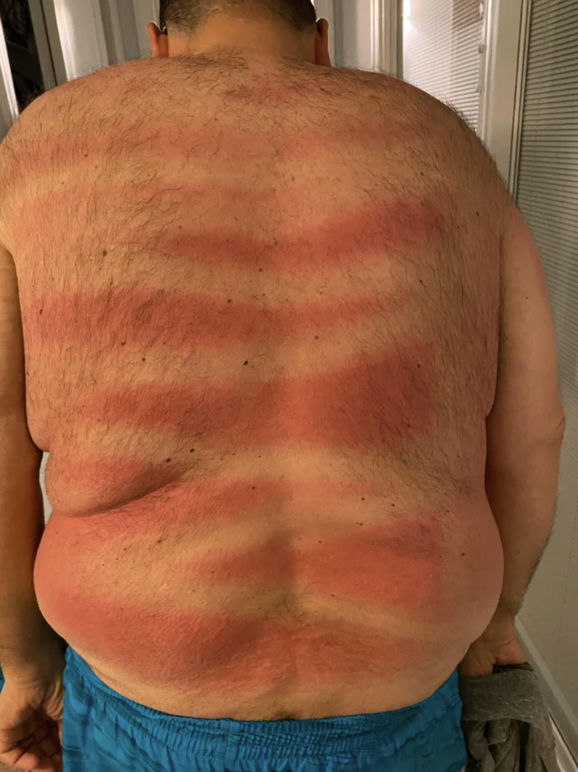 A man with sunburn on his back