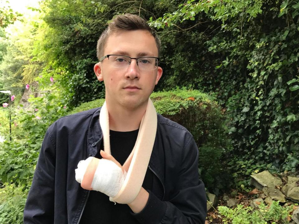 Anthony Seward, 21, had his hand crushed in a mangle in a work accident (SWNS)