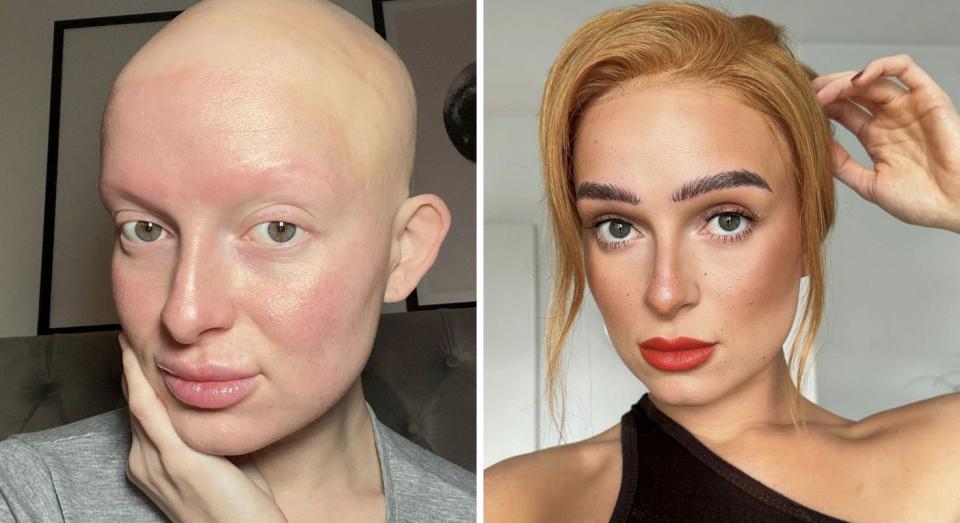 Jess Mullen has revealed how she found her confidence after being diagnosed with alopecia. (Jess Mullen/SWNS)