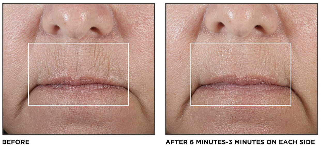 Close up on woman's mouth showing before and after 6 minutes with the NuFace machine