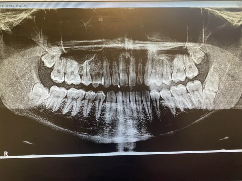 An x ray showing a full scan of someone's mouth and 2 wisdom teeth on the bottom right where there should be just one