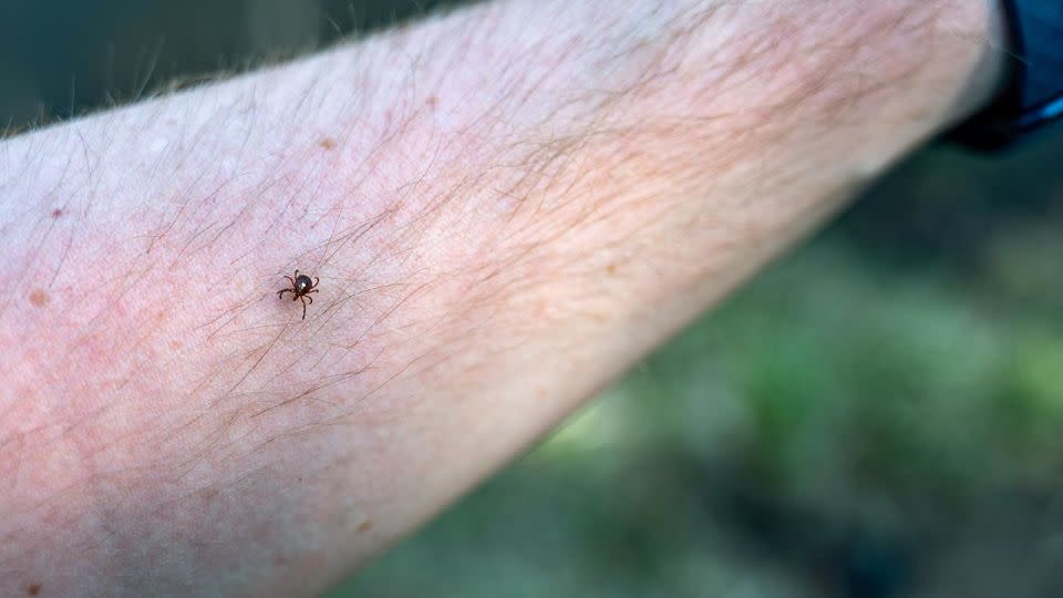 Be careful when removing a tick from your skin. Using tweezers, get the tick by its head as close to the skin as possible and pull it straight out. - Lost_in_the_Midwest/Alamy Stock Photo