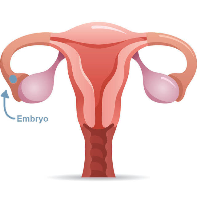 Ectopic Pregnancy