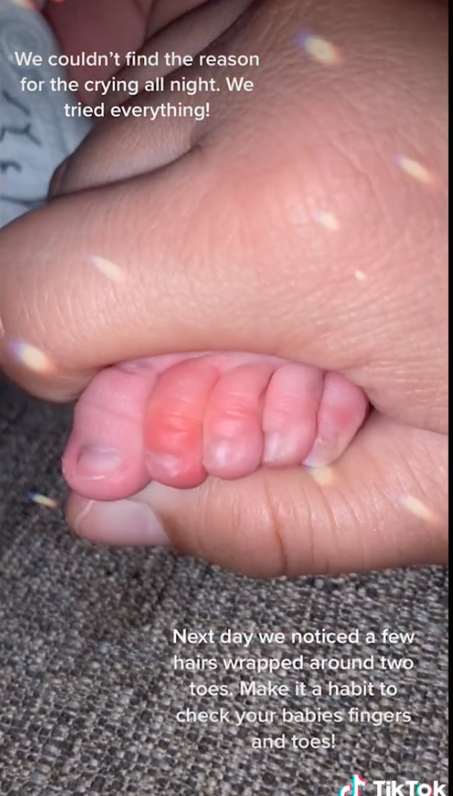 Baby swollen toe