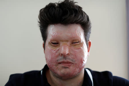 Acid attack victim Andreas Christopheros, poses for a photograph in his home in Truro, south-west England, Britain July 31, 2017. REUTERS/Peter Nicholls