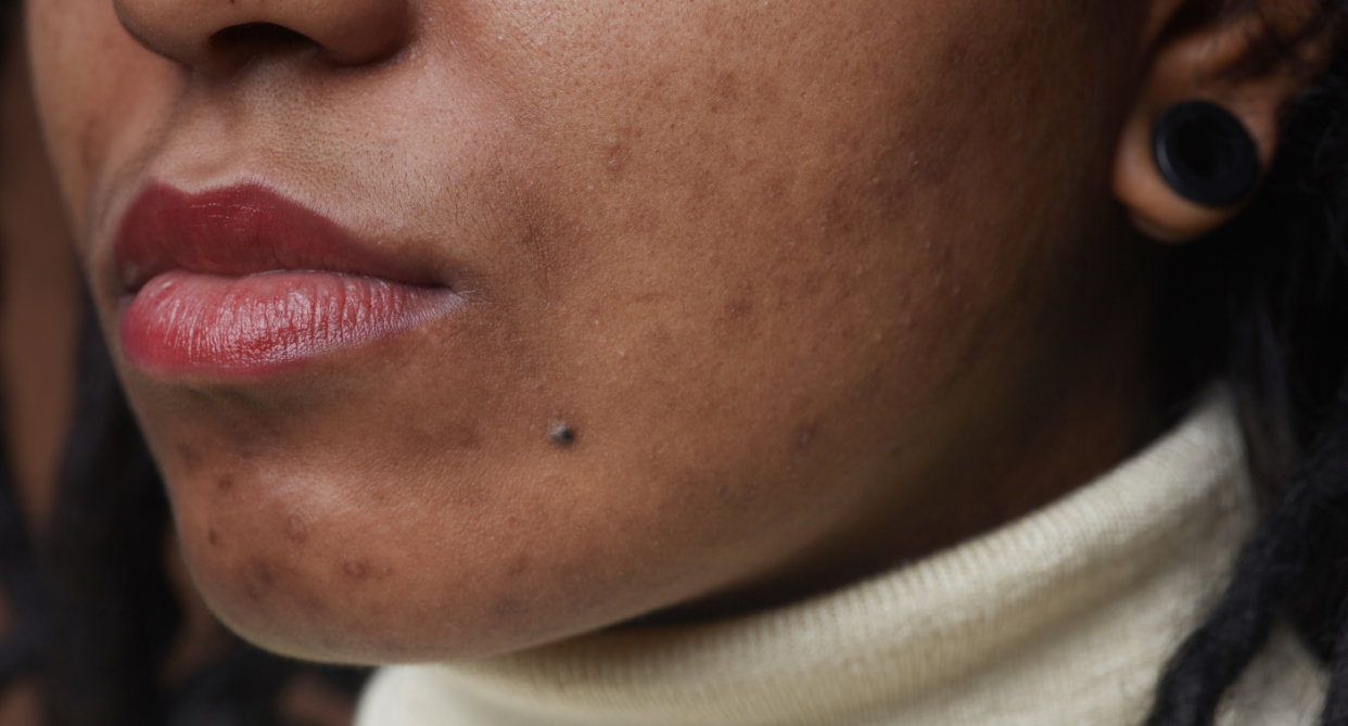 Acne hormonal coil. (Getty Images)