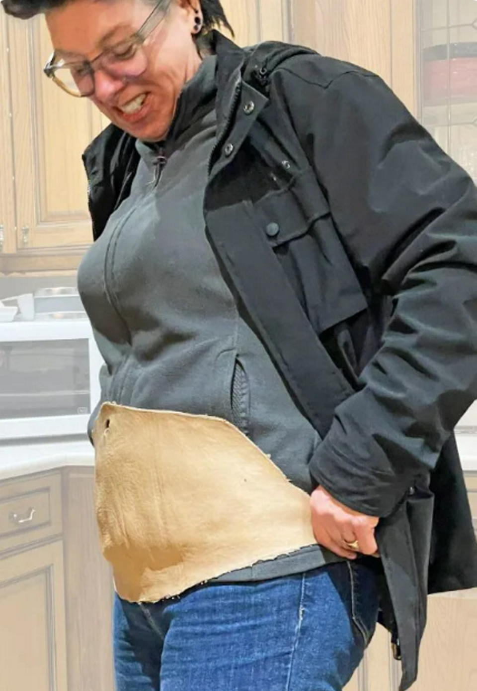 Katie with the removed skin after her weight loss surgery. (SWNS)