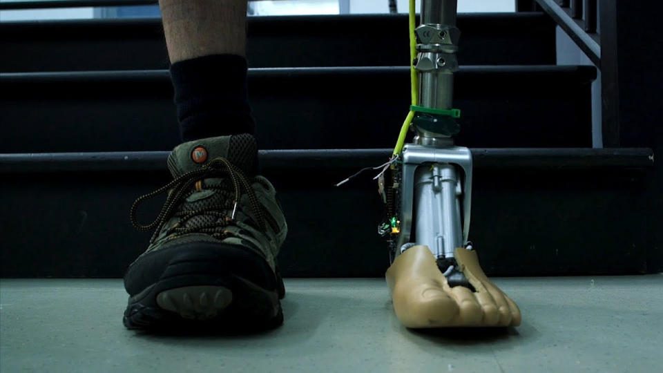 Prosthetic limbs have evolved considerably from the rudimentary wooden