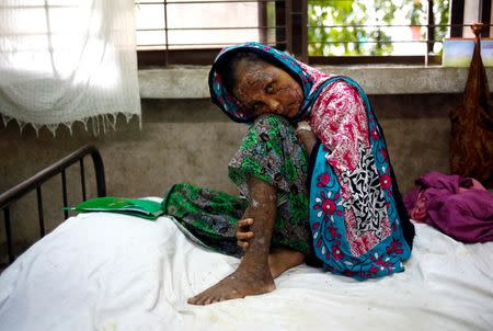 Shaheda, 40, a Rohingya refugee woman who said her body was burnt when the Myanmar army set fire to her house, receives treatment at the Cox's Bazar District Sadar Hospital in Cox's Bazar, Bangladesh, September 19, 2017. REUTERS/Mohammad Ponir Hossain