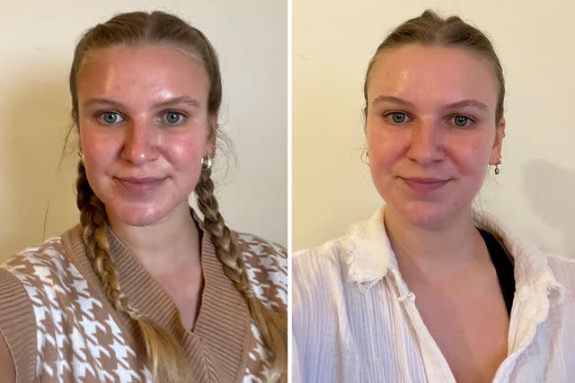 <p>Courtesy of Tessa Petak</p> Left: Before first treatment. Right: Three weeks after third treatment.