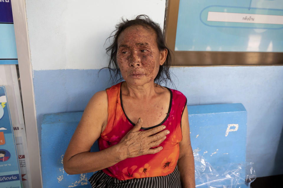 FILE - In this Tuesday March 30, 2021, file photo, an injured Karen villager from Myanmar rests at Ban Mae Sam Laep Health Center in Mae Hong Son province, northern Thailand, after they crossed Salawin river on a boat. Far away in Myanmar’s borderlands, millions of others who hail from Myanmar’s minority ethnic groups are facing increasing uncertainty and waning security as longstanding conflicts between the military and minority guerrilla armies flare anew. (AP Photo/Sakchai Lalit, File)