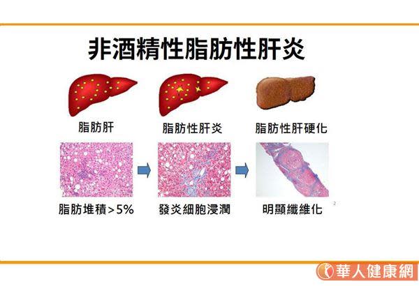 脂肪肝與新陳代謝症候群密切相關！名醫：體重減輕5%，就能逆轉脂肪肝