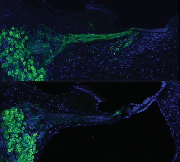 Comparison of the cochlear nerve after neurotrophin gene therapy (top) versus the untreated cochlea from the same animal (bottom).