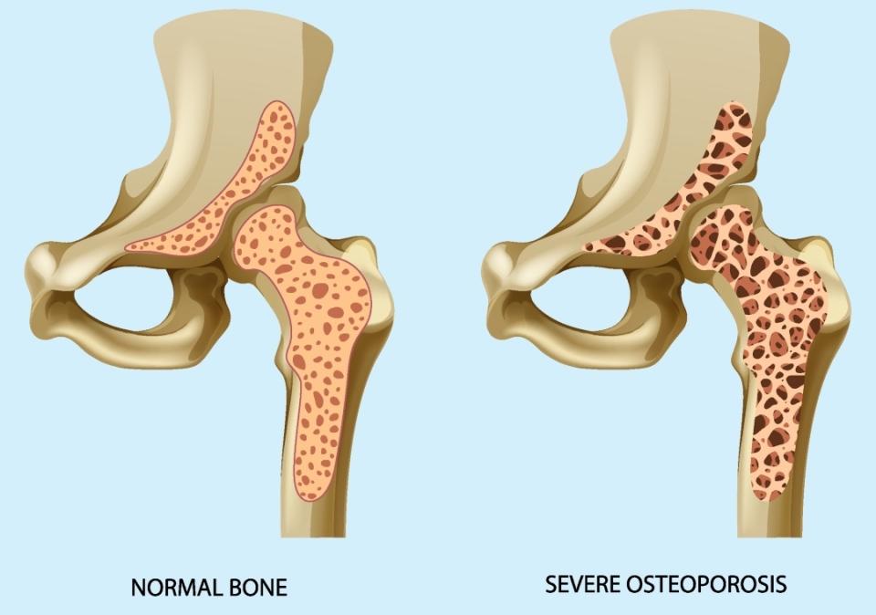 Weak bones bolstered by red sage plant