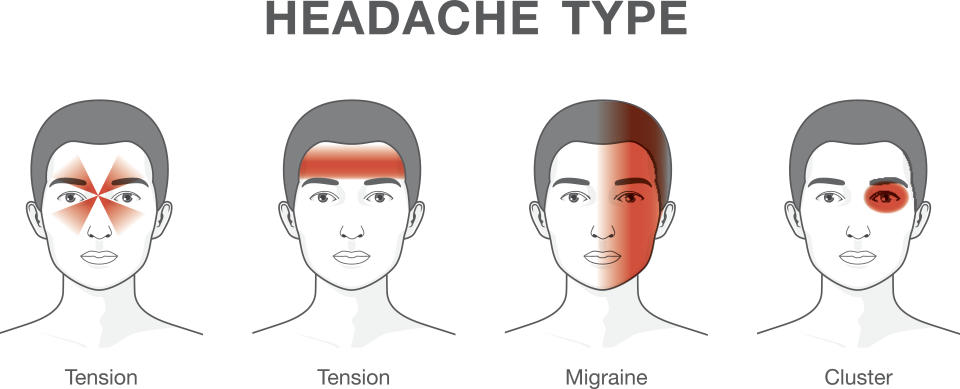 La ilustration muestra cuatro tipos difrentes de dolor de cabeza. Los dos primeros serían tensionales. (Foto:Getty)