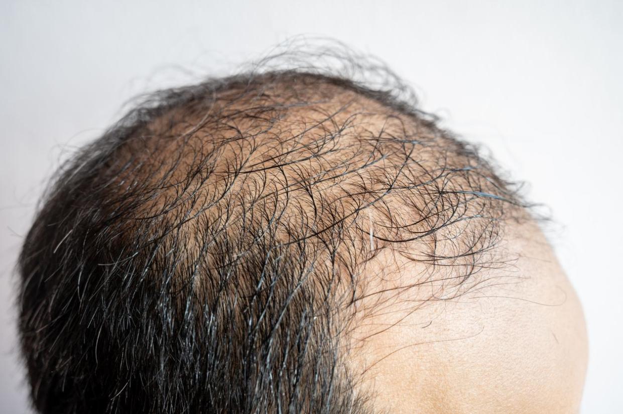 Side view of baldness men's head