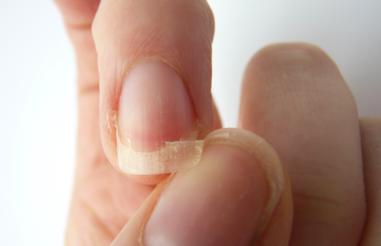 A cracked nail isn’t a reason for hospital, surprisingly. (Picture: Getty)