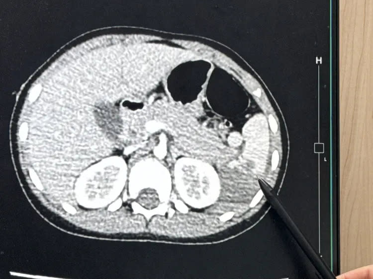  6歲女童站機車踏板上遇車禍，脾臟破裂切除3分之2。院方提供