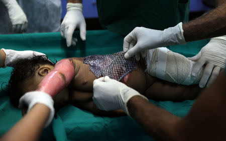 Doctors wrap a child's burnt skin with sterilised tilapia fish skin at Dr. Jose Frota Institute in the northeastern costal city of Fortaleza, Brazil, May 3, 2017. REUTERS/Paulo Whitaker