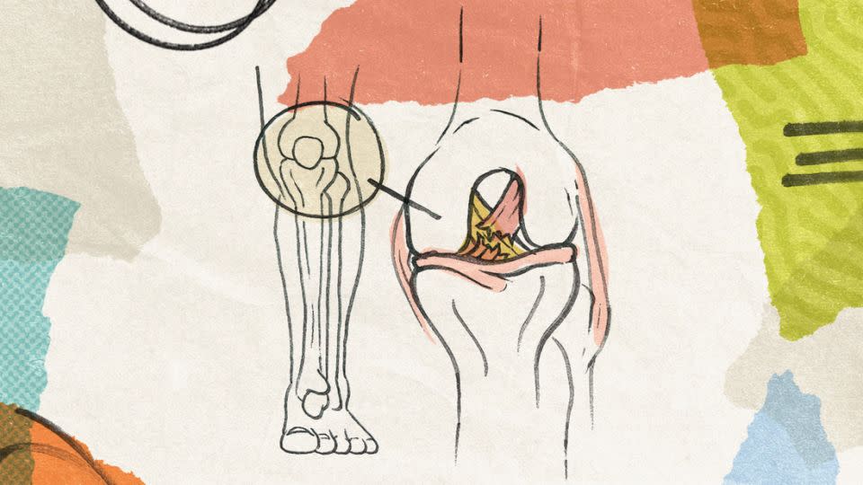 The ACL is one of the key ligaments inside the knee. It joins the thigh bone to the shin bone and keeps the knee stable. - Leah Abucayan