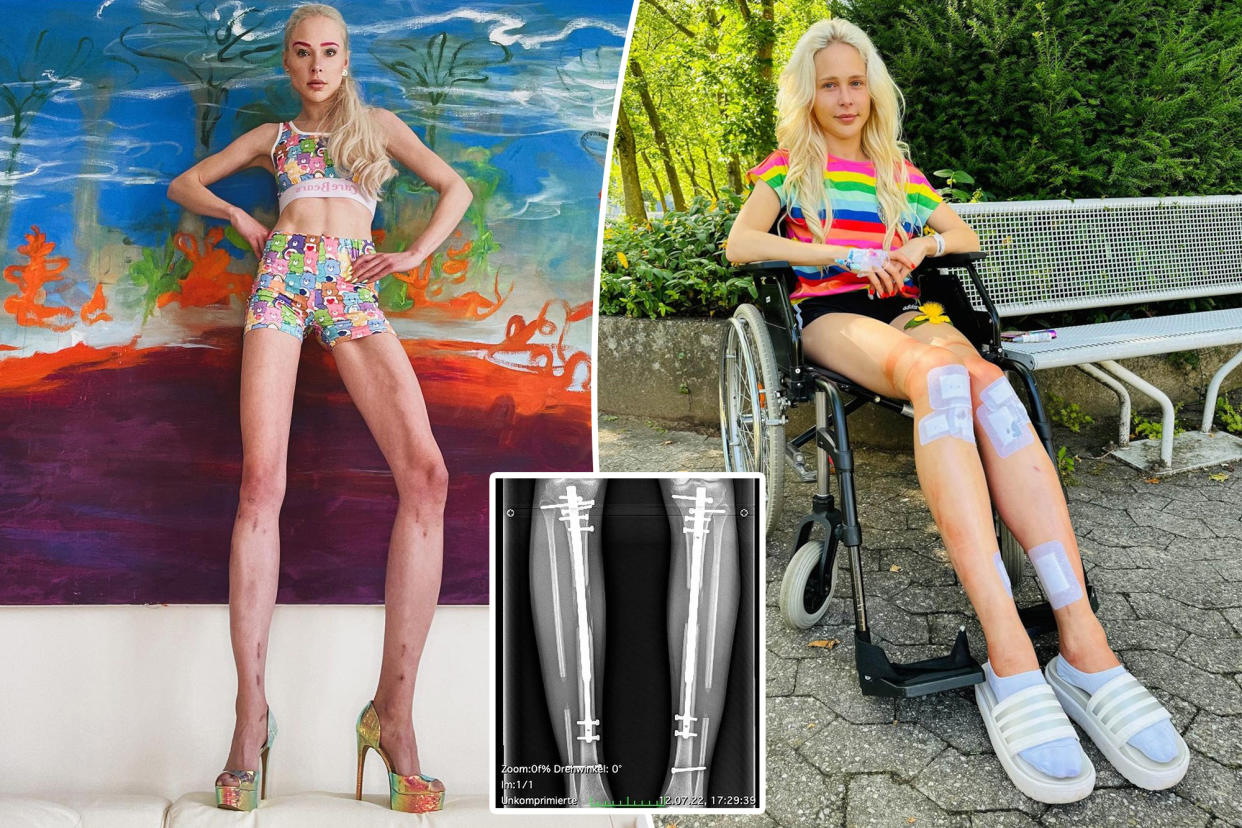 (Left) from the city of Hamburg, Germany, posing with her hands on her hips. (Right) Fischer in wheelchair. (Inset) X-ray of legs.