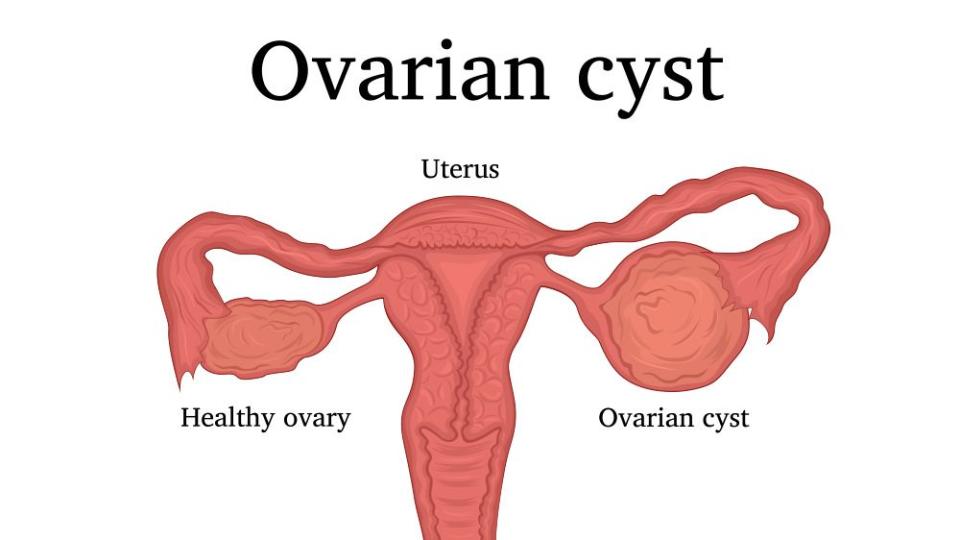 ovarian cyst symptoms