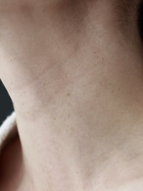 lines in neck 