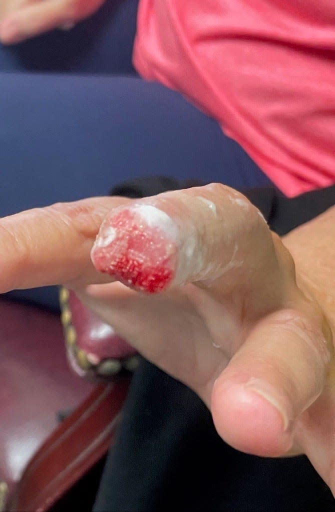 Bobbie Haverly's finger weeks after surgery. Doctors estimate it will take two months for the skin to grow back over the wound.