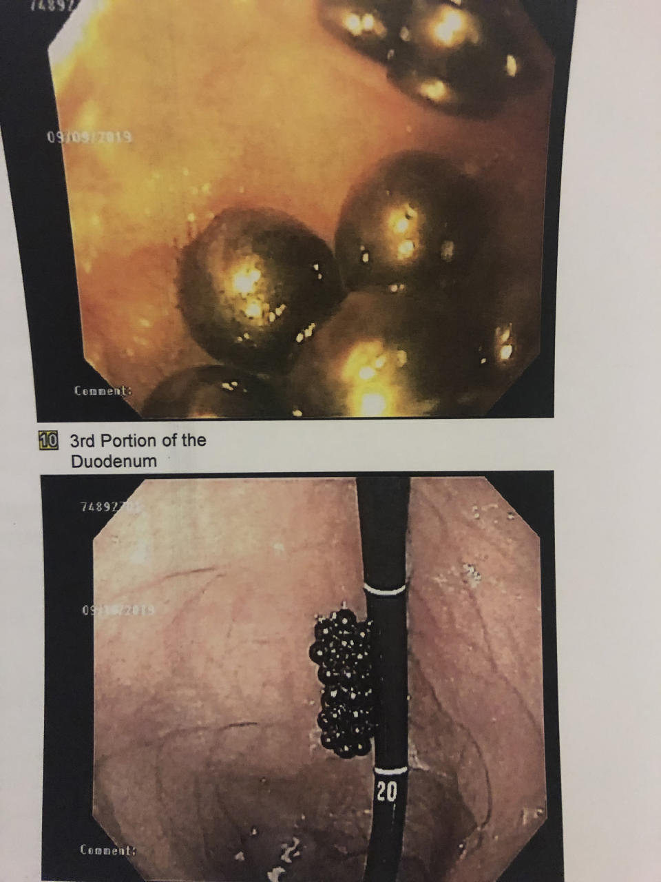 For one scary moment, doctors couldn't see the magnets in Peyton's stomach and thought they had slipped back into his small intestine. They pulled the camera back and realized they were stuck to the scope but still in the stomach. (Courtesy Jessica MacNair)