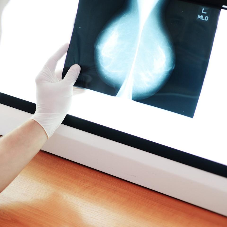 A Lot Has Changed In Breast Cancer Treatment