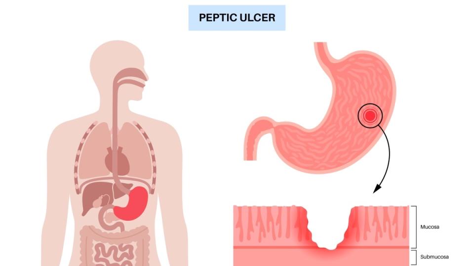 An illustration of a stomach ulcer in a person