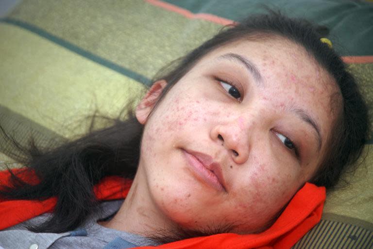 Indonesian maid Erwiana Sulistyaningsih looks on from a hospital bed in Sragen district in central Java island on February 5, 2014