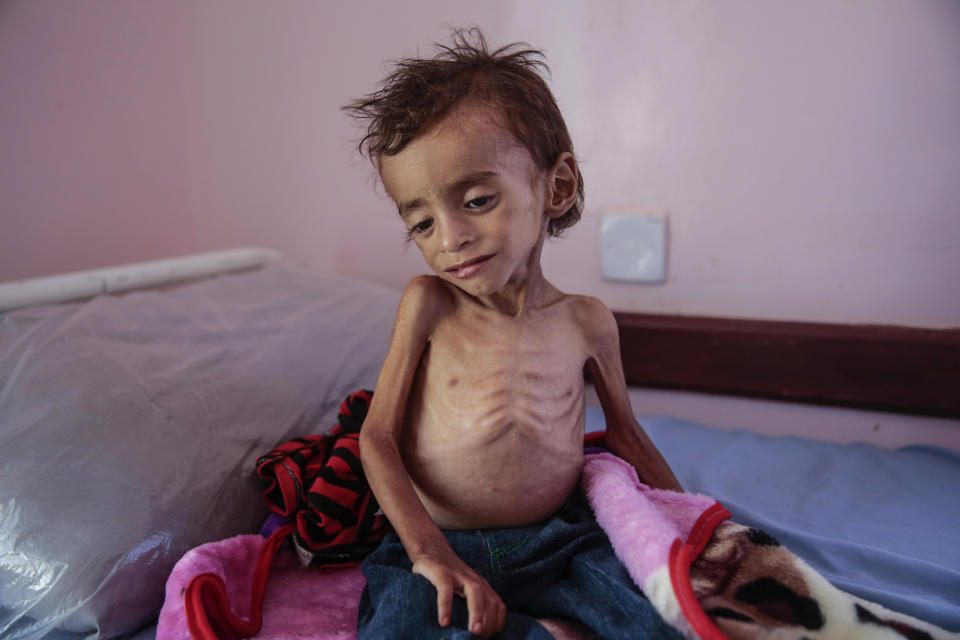 In this Oct. 1, 2018 file photo, a malnourished boy sits on a hospital bed at the Aslam Health Center, Hajjah, Yemen. Houthi rebels in Yemen have blocked half of the United Nations’ aid delivery programs in the war-torn country — a strong-arm tactic to force the agency to give them greater control over the massive humanitarian campaign, along with a cut of billions of dollars in foreign assistance, according to aid officials and internal documents obtained by The Associated Press. (AP Photo/Hani Mohammed, File)