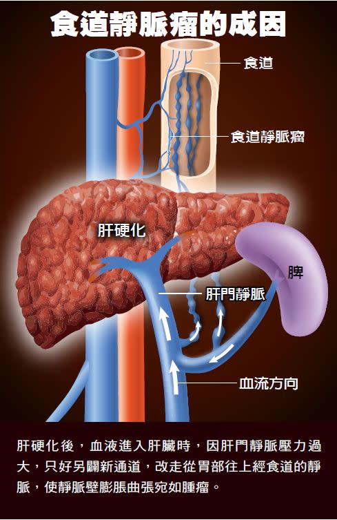 食道靜脈瘤的成因