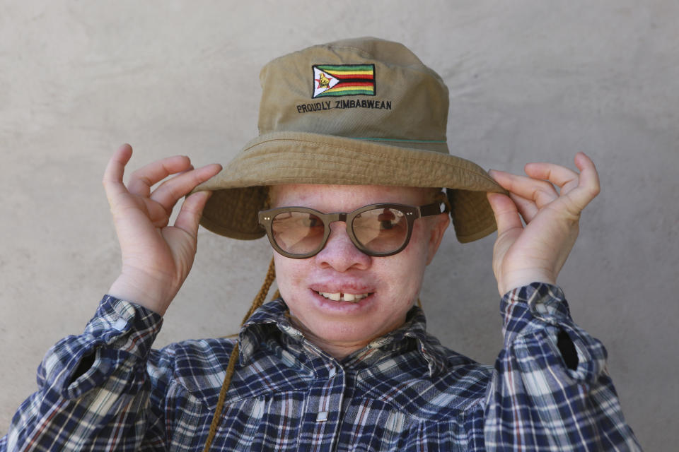 Yvonne Gumbo poses for a photo outside her family home in Harare, in this Tuesday, June, 9, 2020 photo. Each time Gumbo, who has albinism and her "black" friends get together for a picture, she insists on been in the centre." I tell them I make the picture beautiful because I am special," she told the Associated Press at her home in Zimbabwes capital, Harare, recently.(AP Photo/Tsvangirayi Mukwazhi)