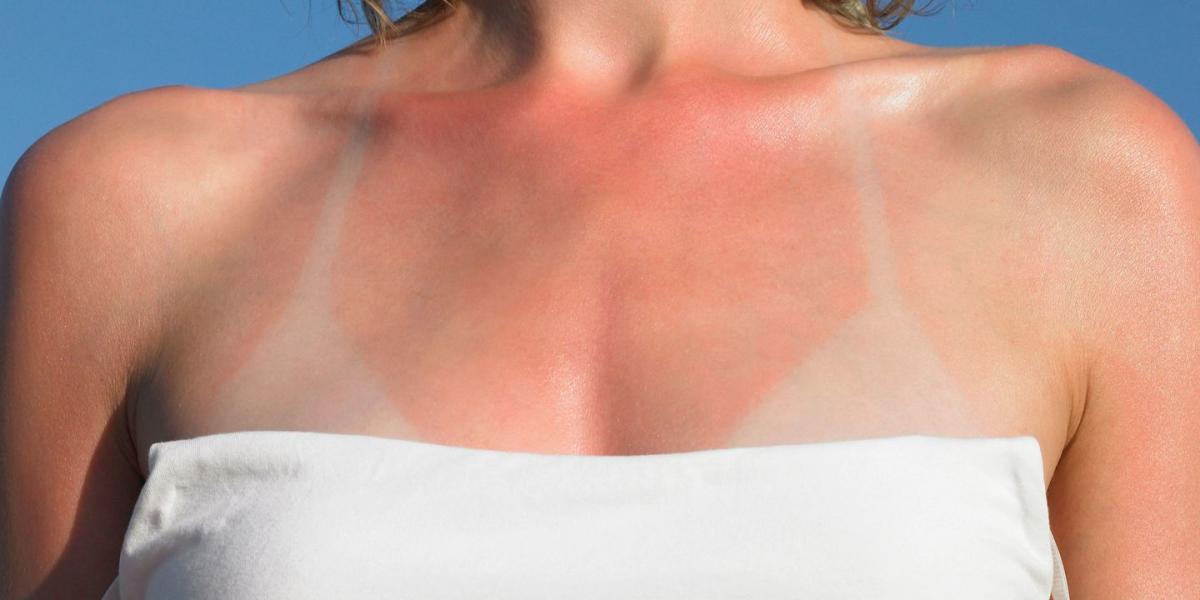 91 Sunburn Couple Stock Photos, High-Res Pictures, and Images - Getty Images